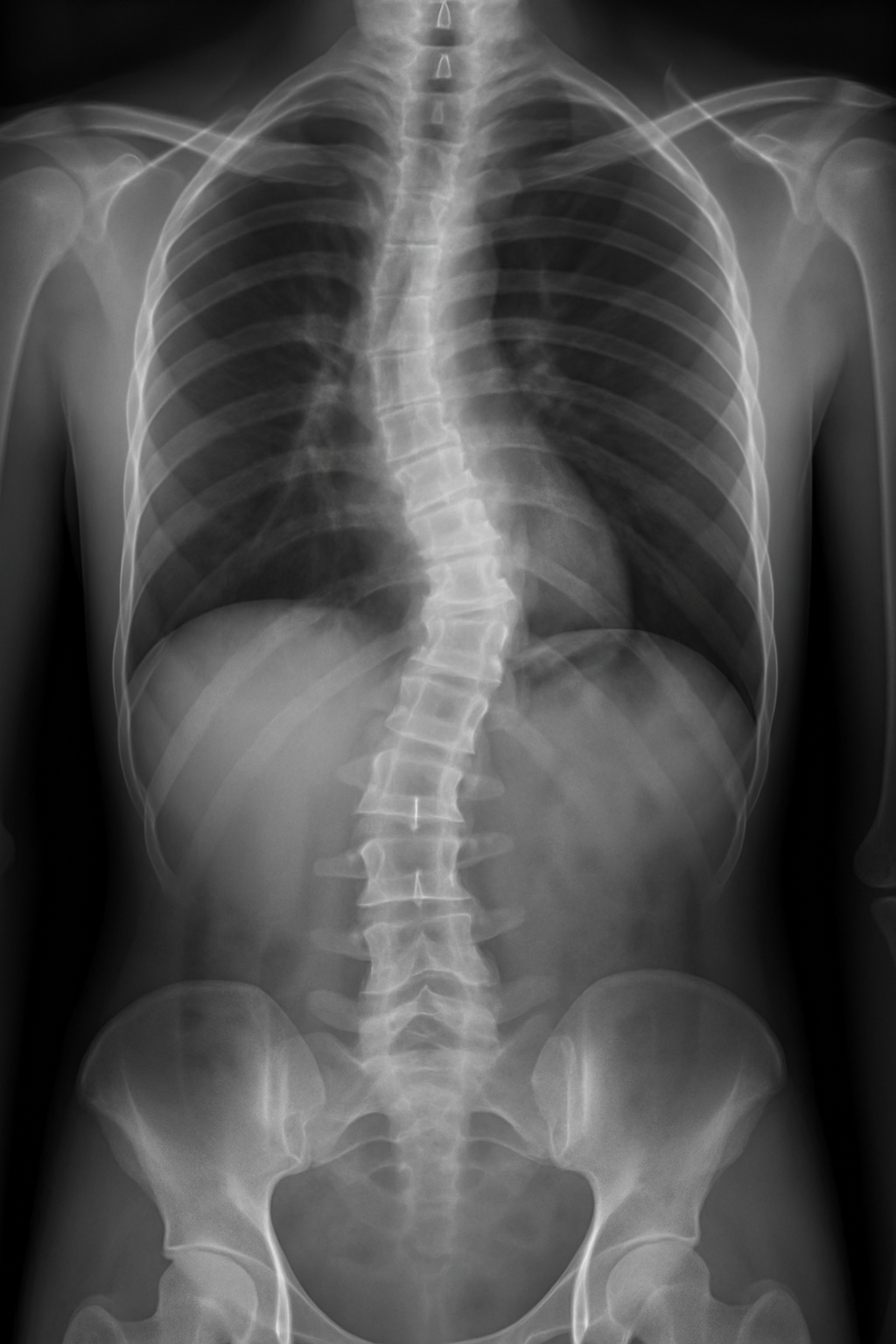 Scoliosi: biomeccanica e vissuti emotivi alla base della curvatura vertebrale, una visione integrata mente-corpo.